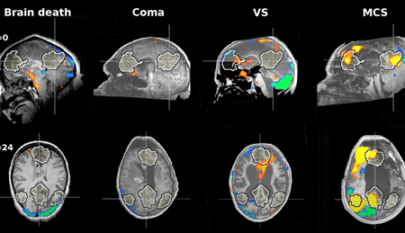 brain death 脳死 Coma 昏睡（状態）VS バイタルサイン、生命兆候 MCS 最小限の意識状態