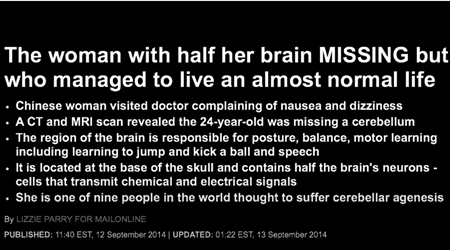 脳の半分が失われたが、ほぼ正常な生活を送ることができた女性