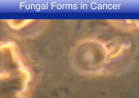 癌における真菌の形態