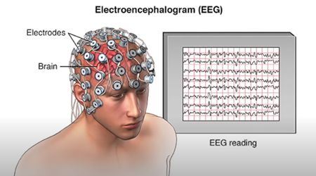 EEG：《医》脳波図